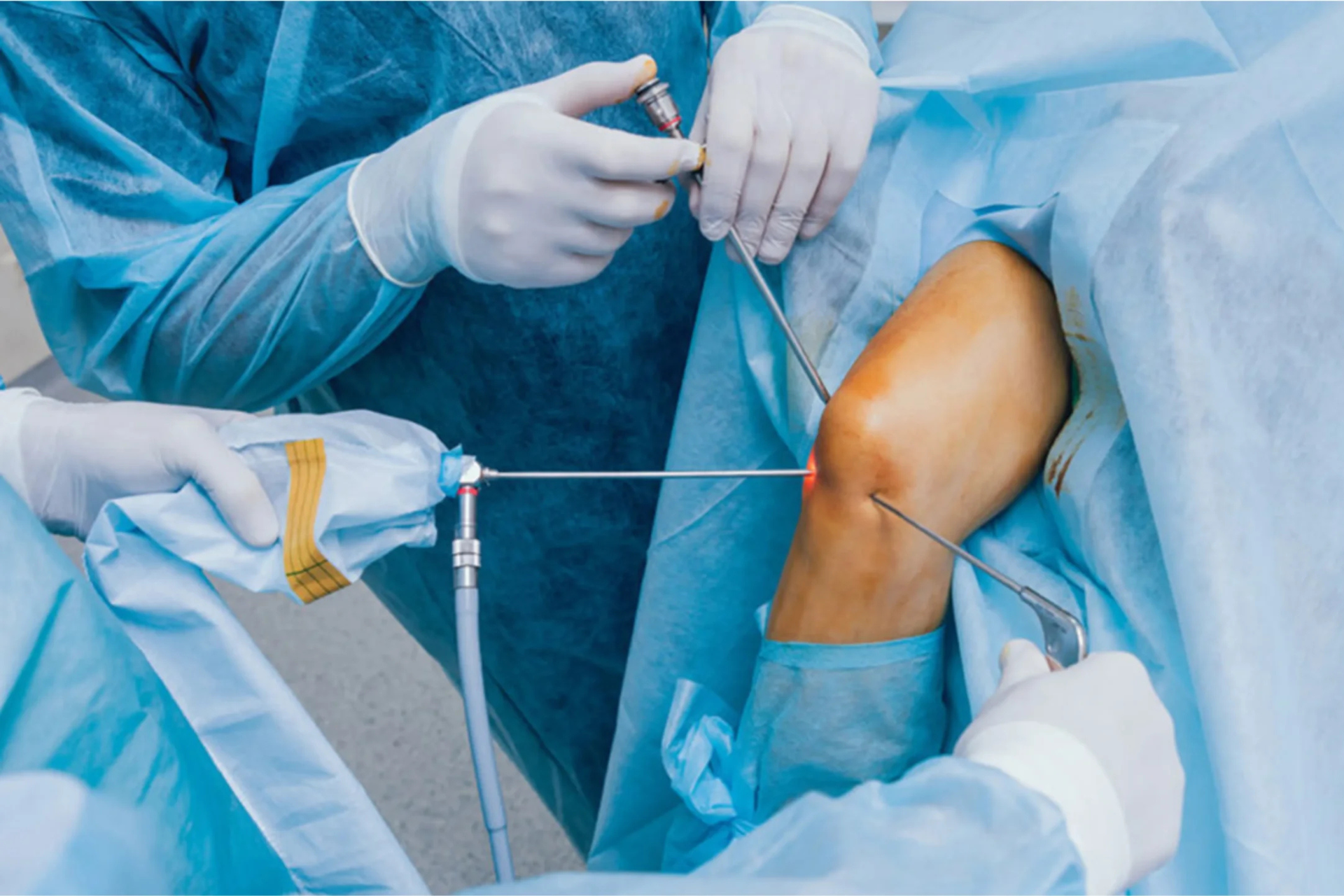 Arthroscopy